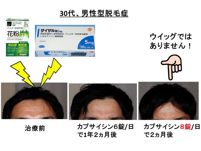 円形脱毛症　病院